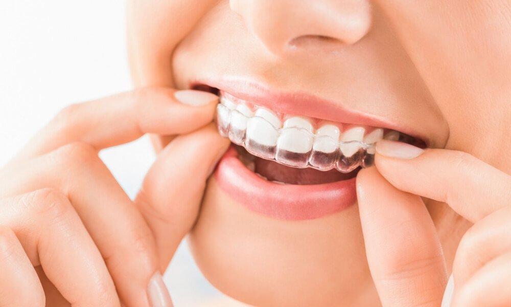 Invisalign treatment 