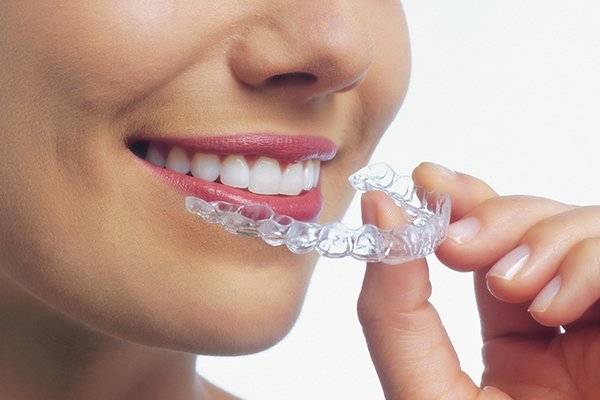 Invisalign