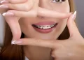 A Short Guide on Practical Advantages of Self-Ligating Braces