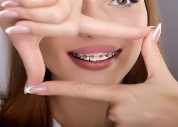 A Short Guide on Practical Advantages of Self-Ligating Braces